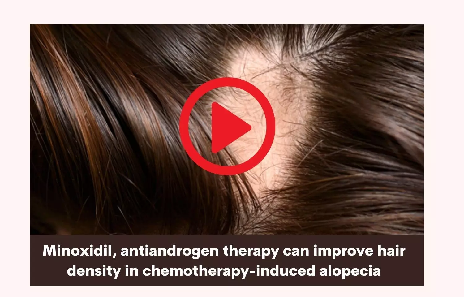 Minoxidil improves hair density in chemotherapy-induced alopecia