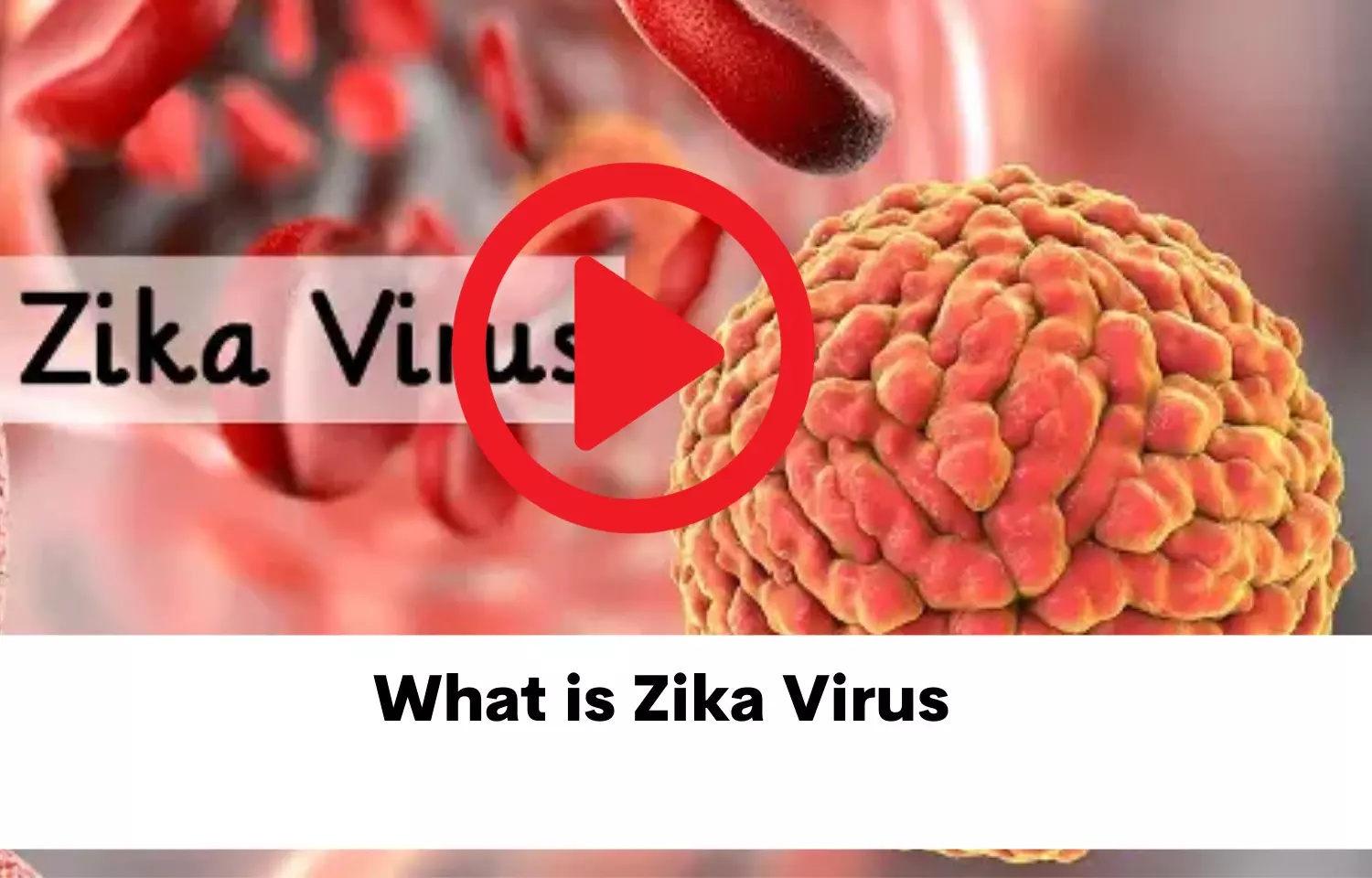 What is Zika virus