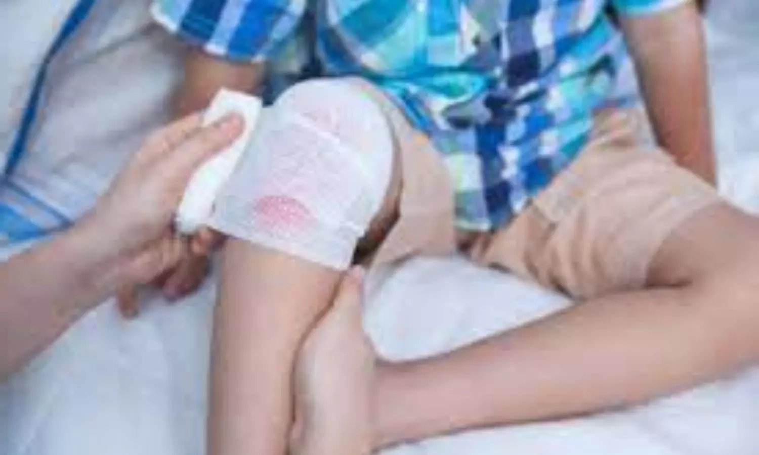Stimuli-responsive dressings can revolutionize burn treatment in children: Study