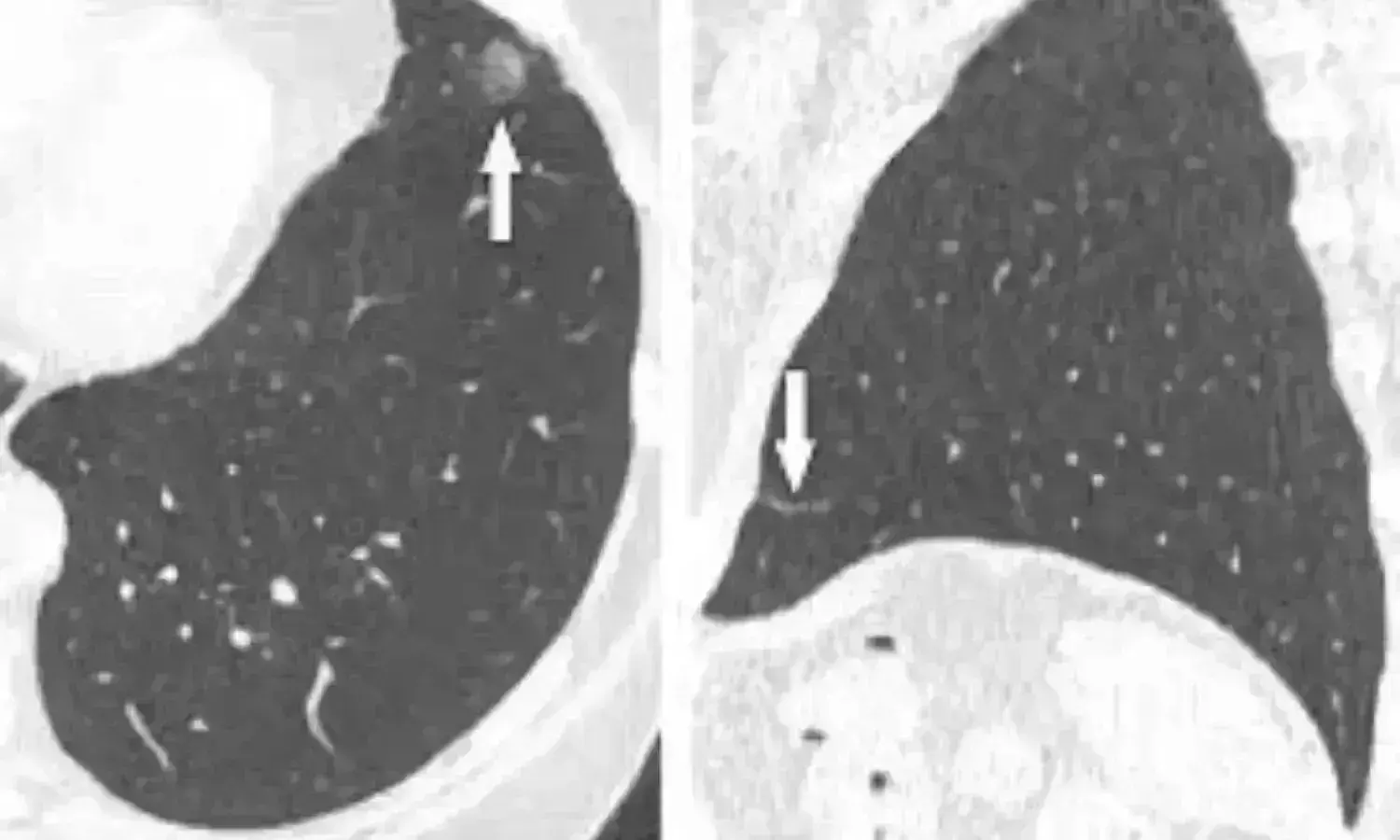Stricter Lung-RADS may help detect cancer risk in nodules on follow-up CT: Study