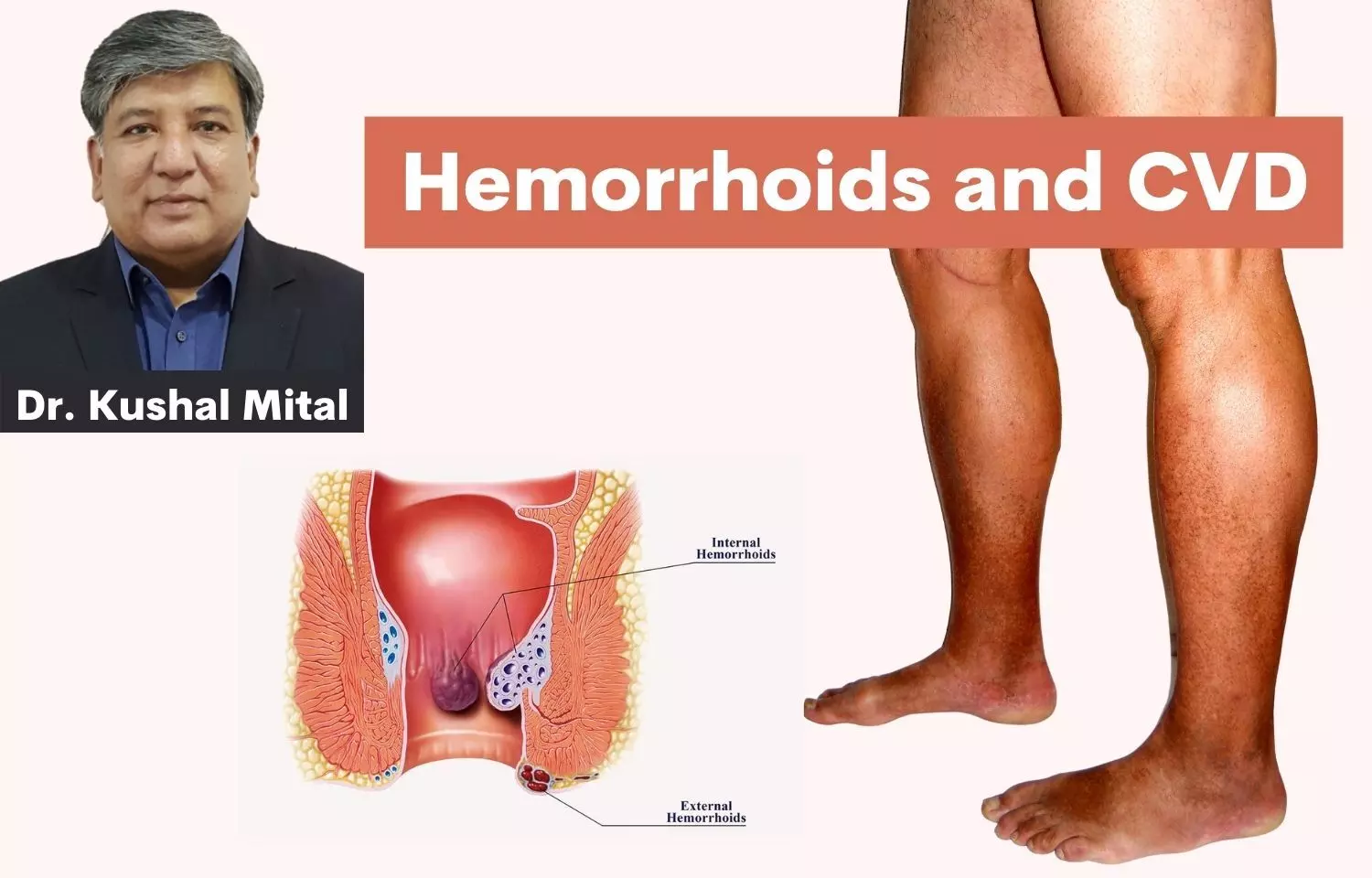 Chorus study revisited- Understanding the common trends of hemorrhoidal disease and chronic venous disease