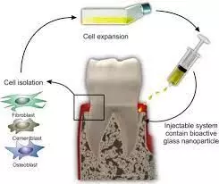 Bioactive glass use highly beneficial as remineralizing additive in dental composites