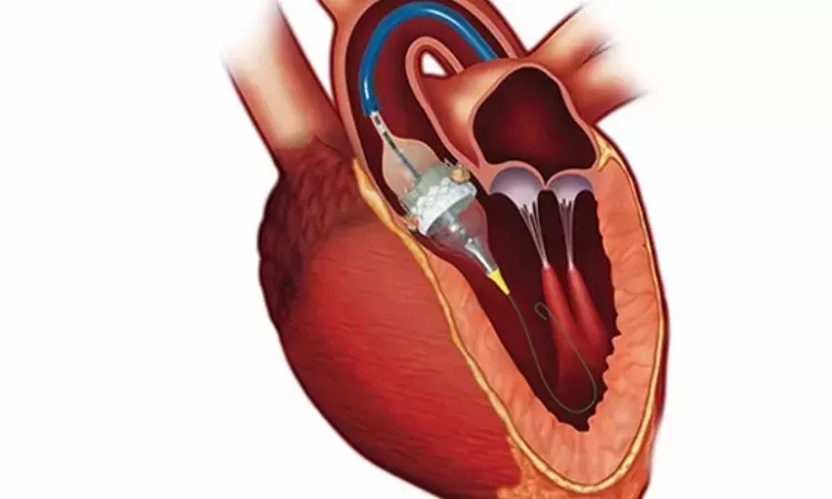 TAVR versus surgery yield similar outcomes at 5 years in intermediate-risk patients: SURTAVI trial