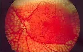 Decreased oxygen delivery to retinal tissue increases retinopathy risk in young T1D patients: Study