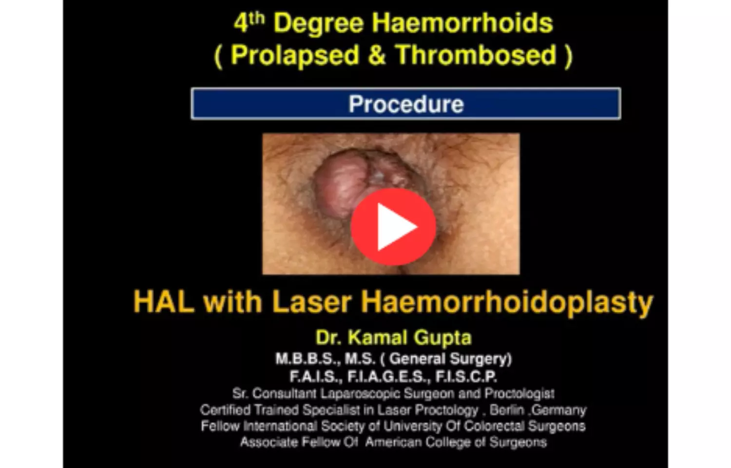 4th Degree Haemorrhoids Prolapsed and Thrombosed Piles