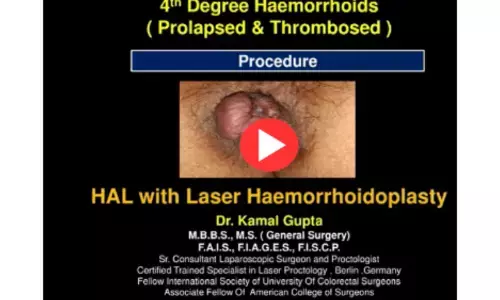 4th Degree Haemorrhoids Prolapsed and Thrombosed Piles