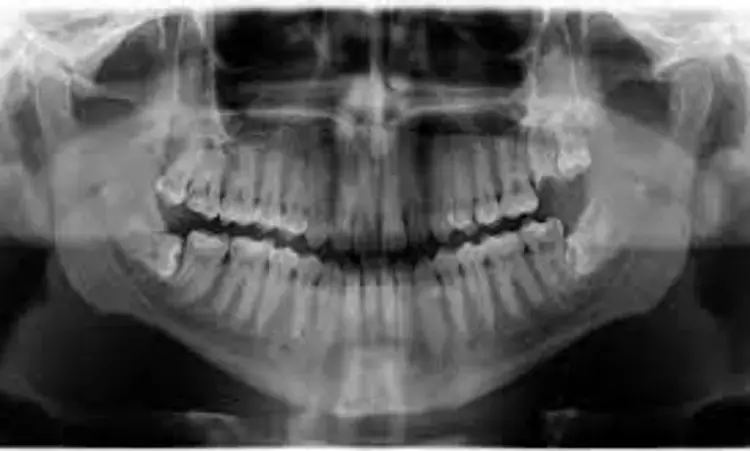 Digital enhancements fails to improve radiographic detection of dental calculus: Study