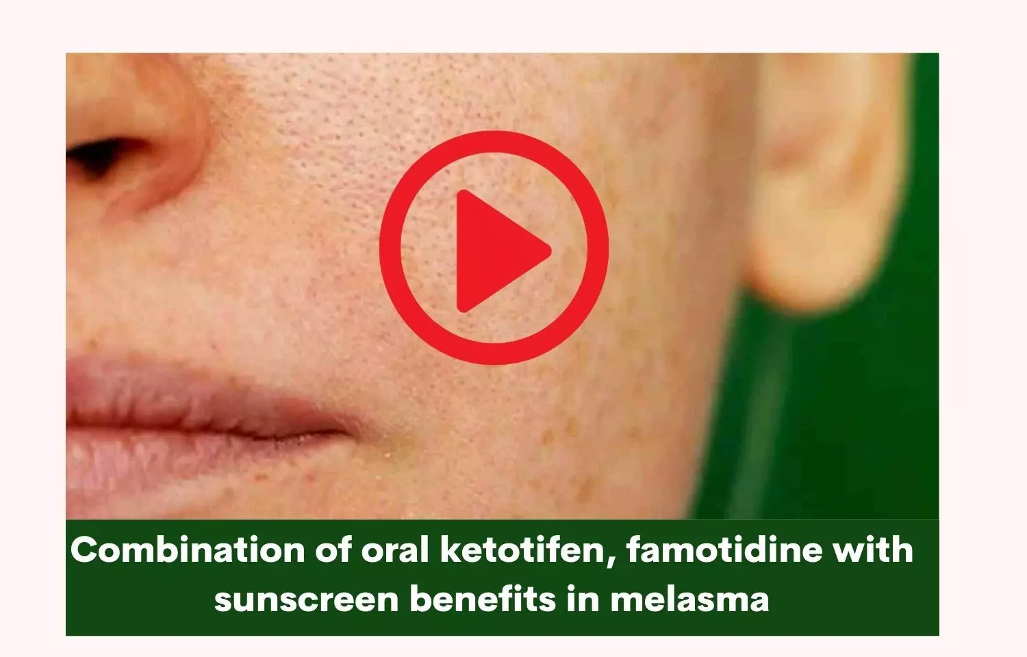 Combination of oral ketotifen, famotidine with sunscreen benefits in melasma