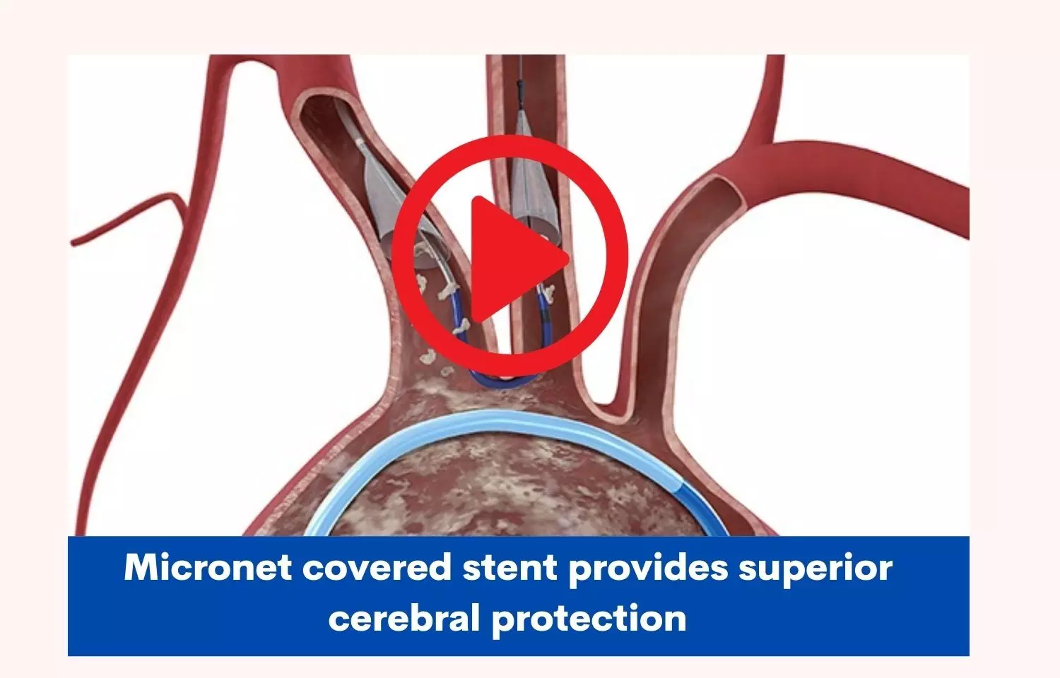 Micronet covered stent provides superior cerebral protection