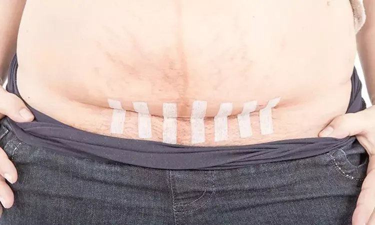 Layered closure of upper abdominal transverse incisions carry a lower risk of incisional-SSIs: study