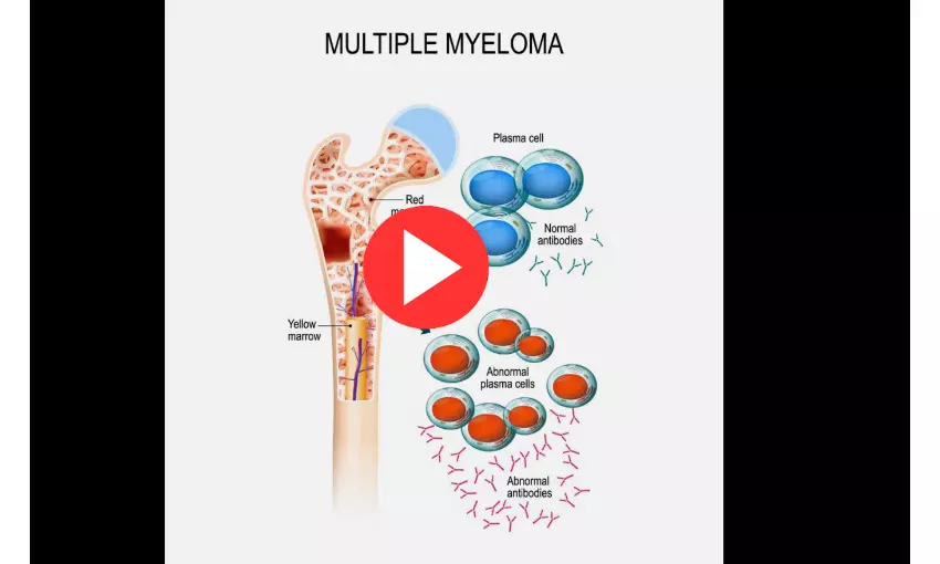 Multiple Myeloma: Diagnosis, Prevention and Treatment