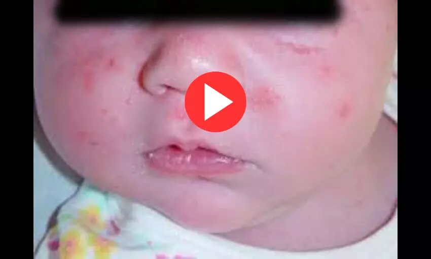 Acne in Neonates, Infants and Pre-pubertal children