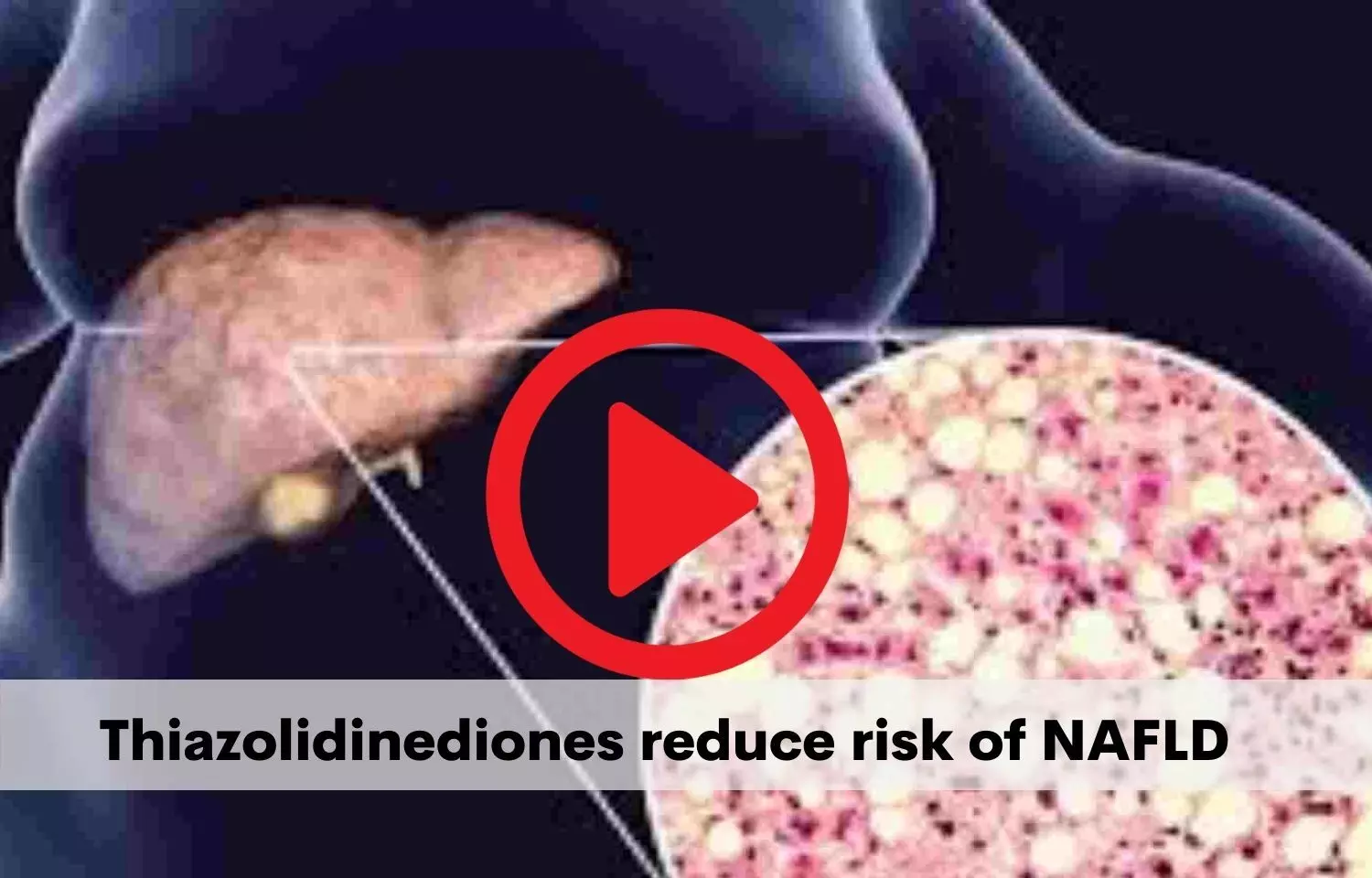 Thiazolidinediones reduce risk of NAFLD