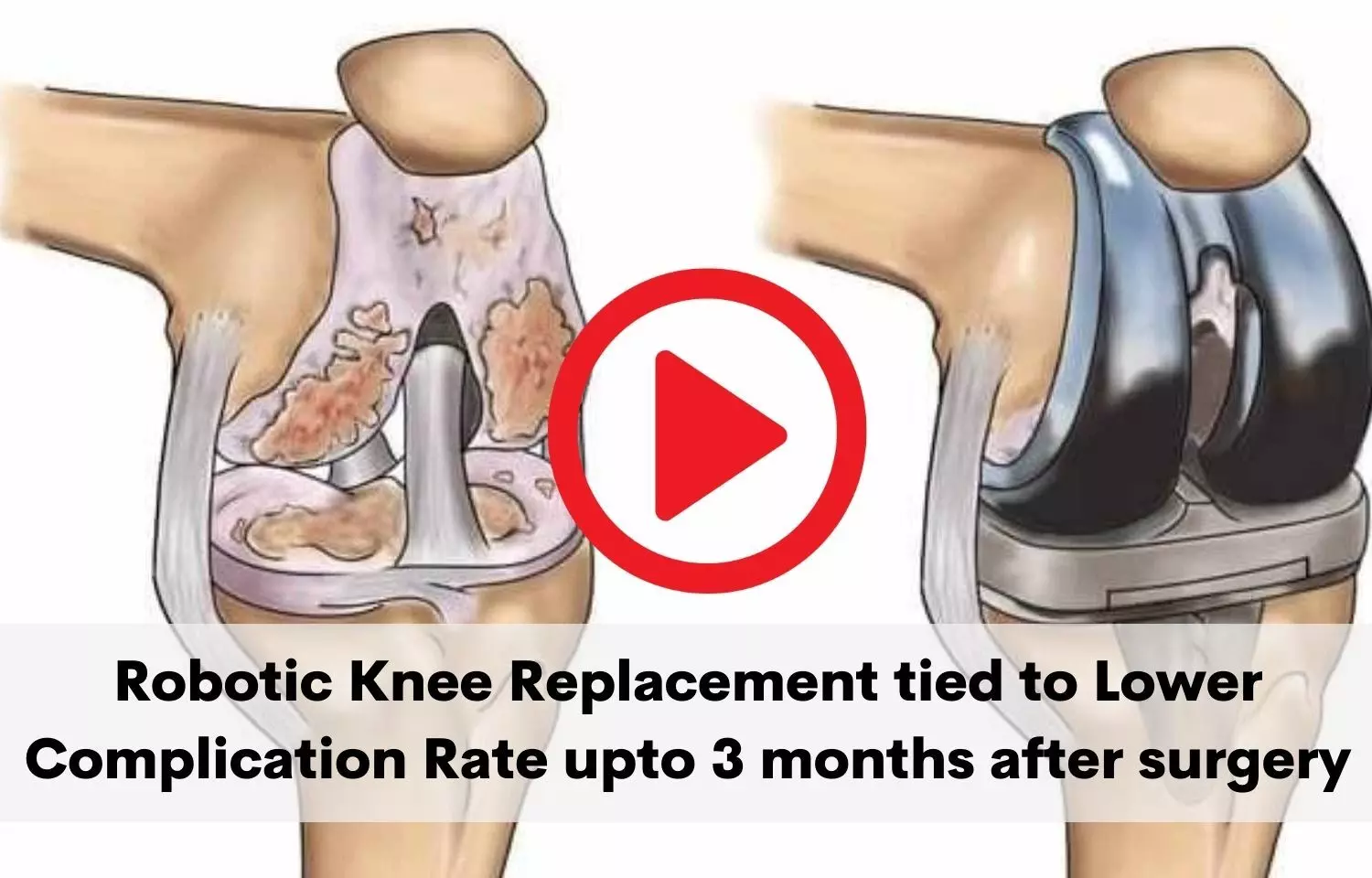 Robotic knee replacement reduces complication risk upto 3 months