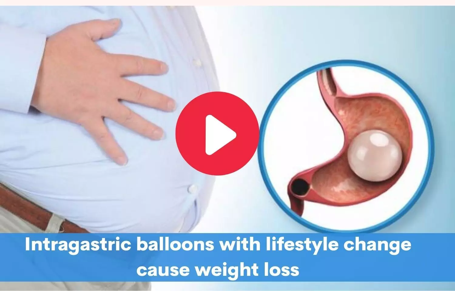 Intragastric balloons combined with lifestyle modifications can help control weight