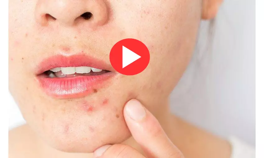 An overview of adult acne by Dr. Amit Vij