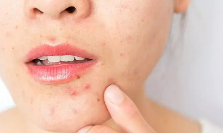 Facial acne: Mandelic acid peel as effective as salicylic acid peel, study finds