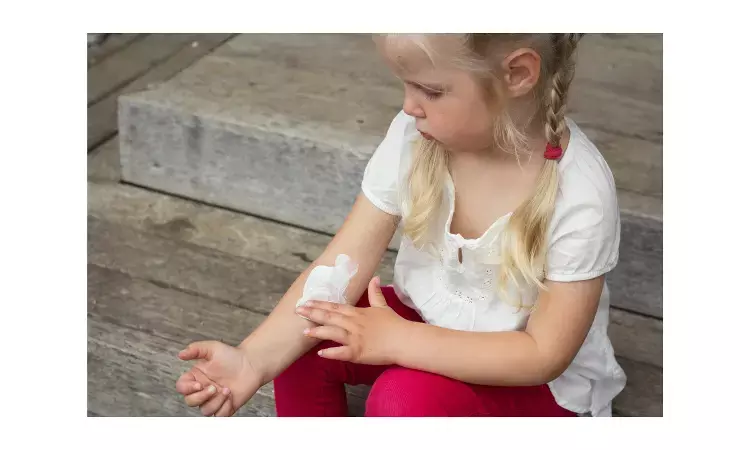 Nemolizumab plus topical agents effective against atopic dermatitis and pruritus in children: Study