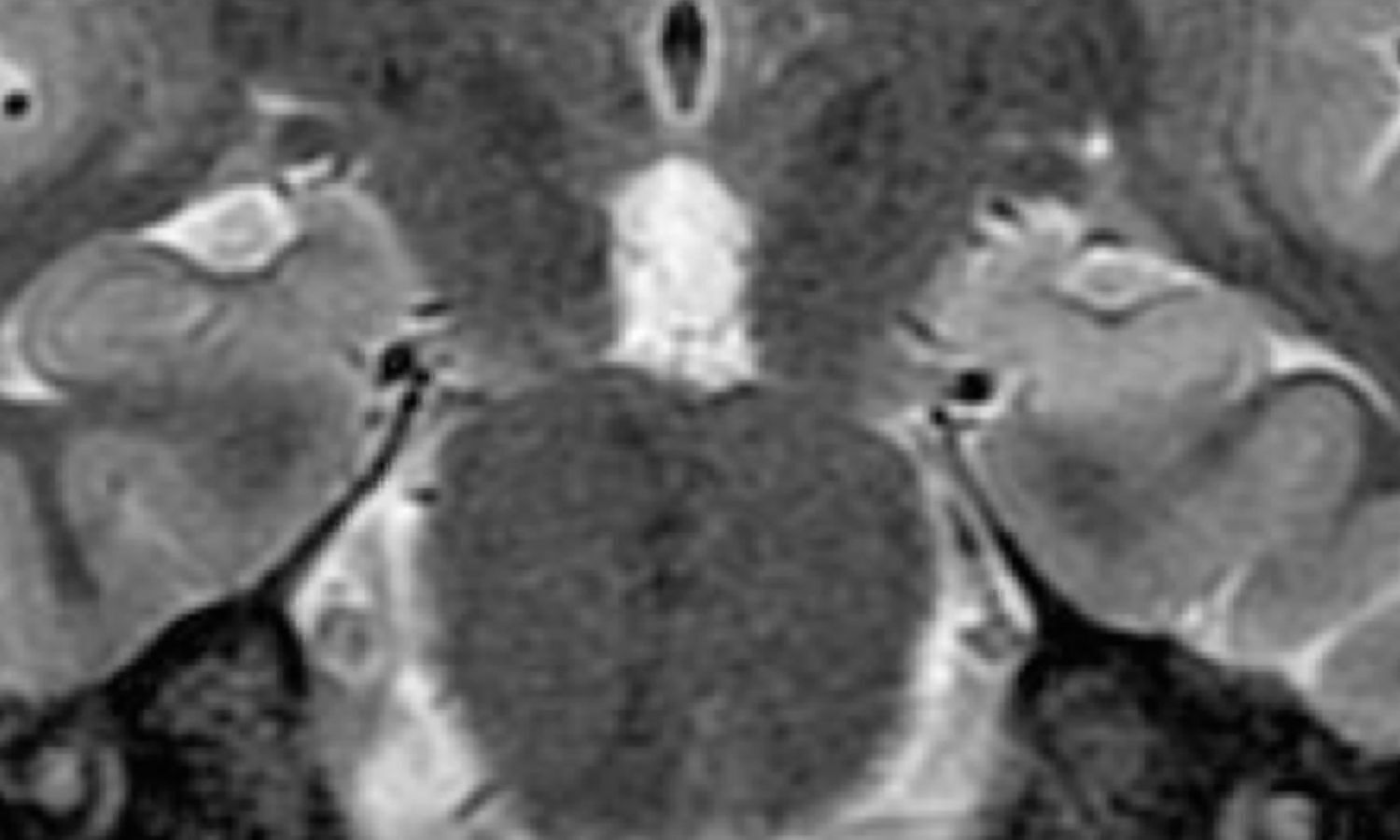 PET/MRI helpful in difficult cases of epilepsy: Study