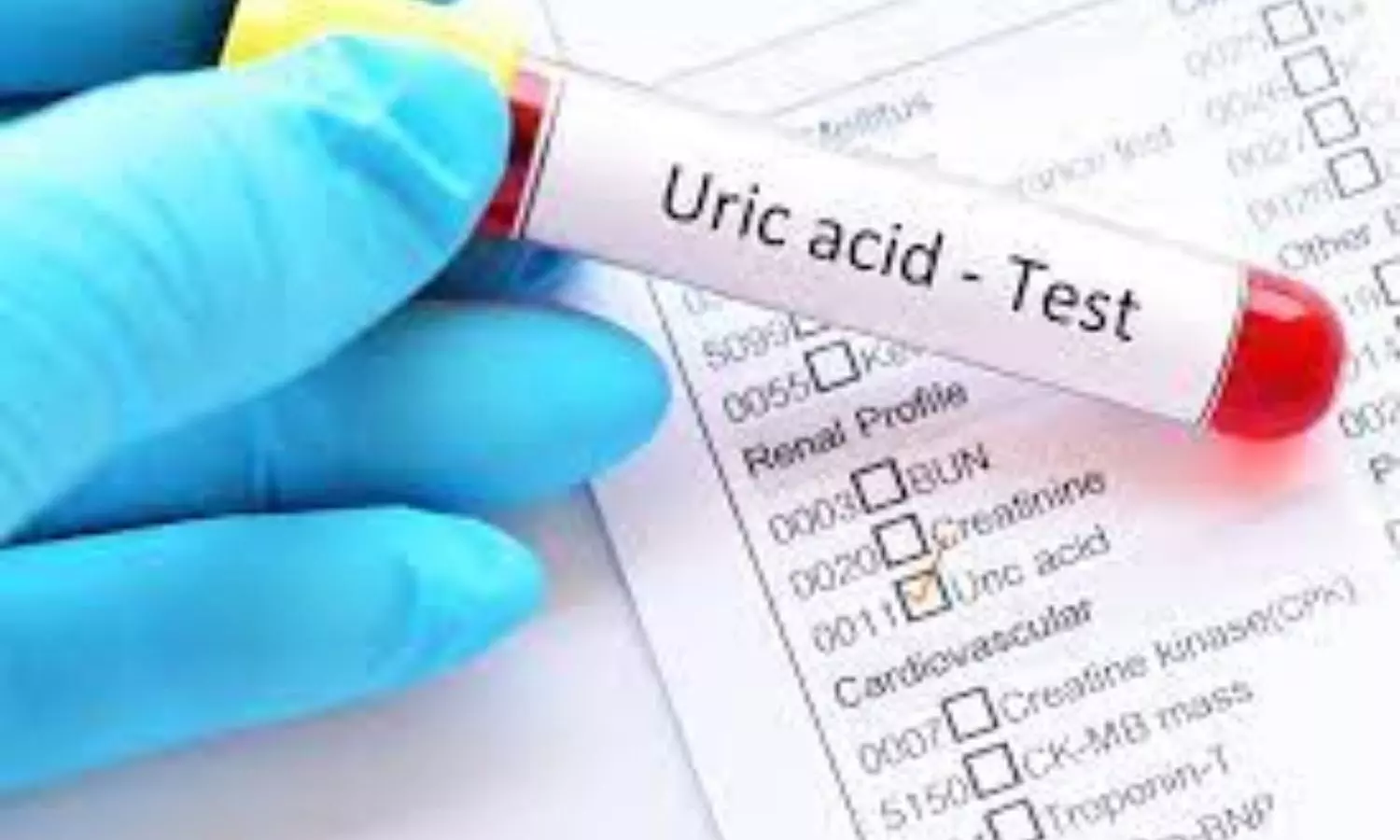 Multiple serum urate testing not superior to single test for gout prediction over time: Study