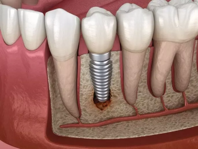 Poor maintenance of implant hygiene associated with peri-implant diseases: Study