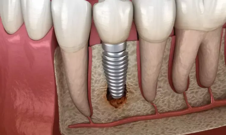 Poor maintenance of implant hygiene associated with peri-implant diseases: Study