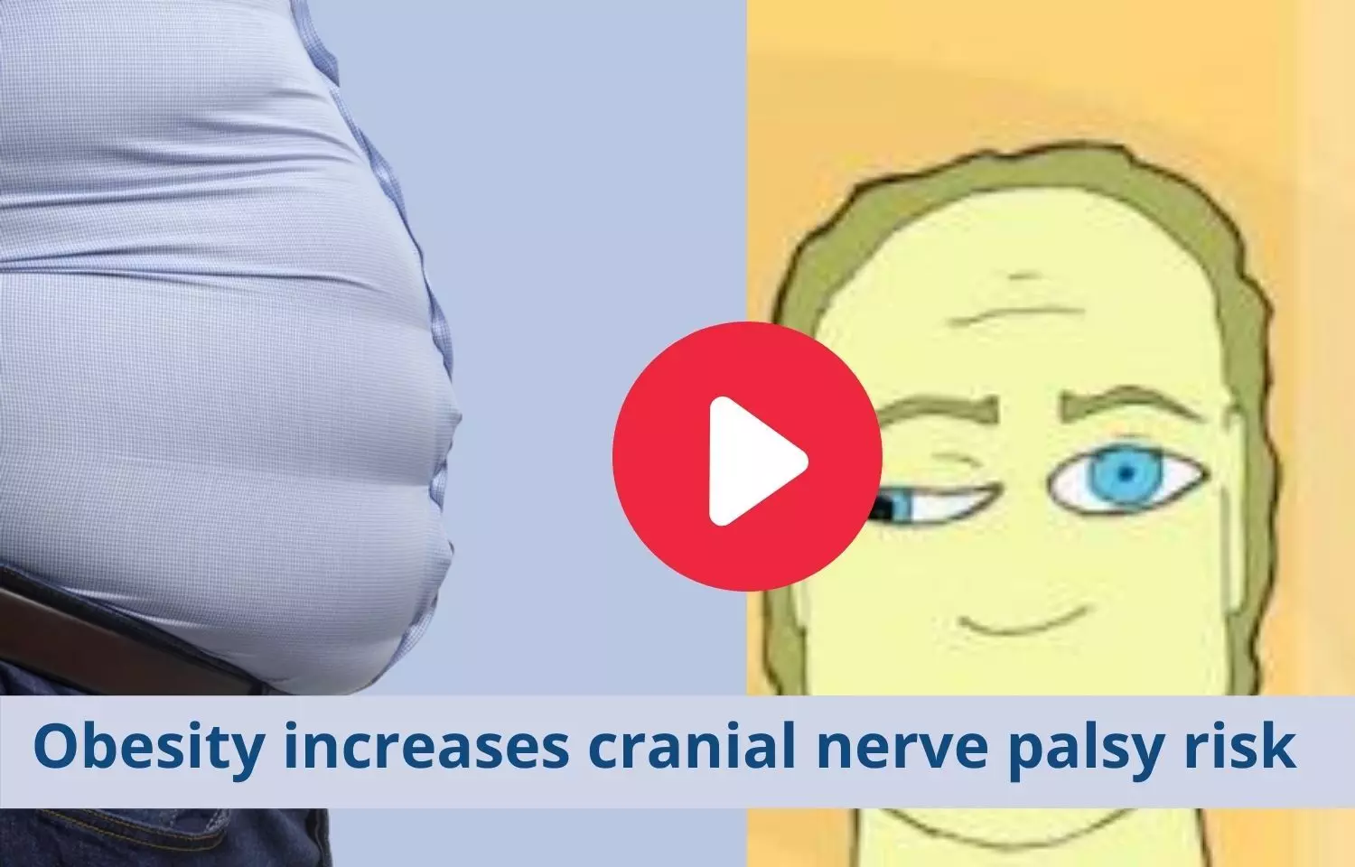 Cranial nerve palsy risk tied to obesity