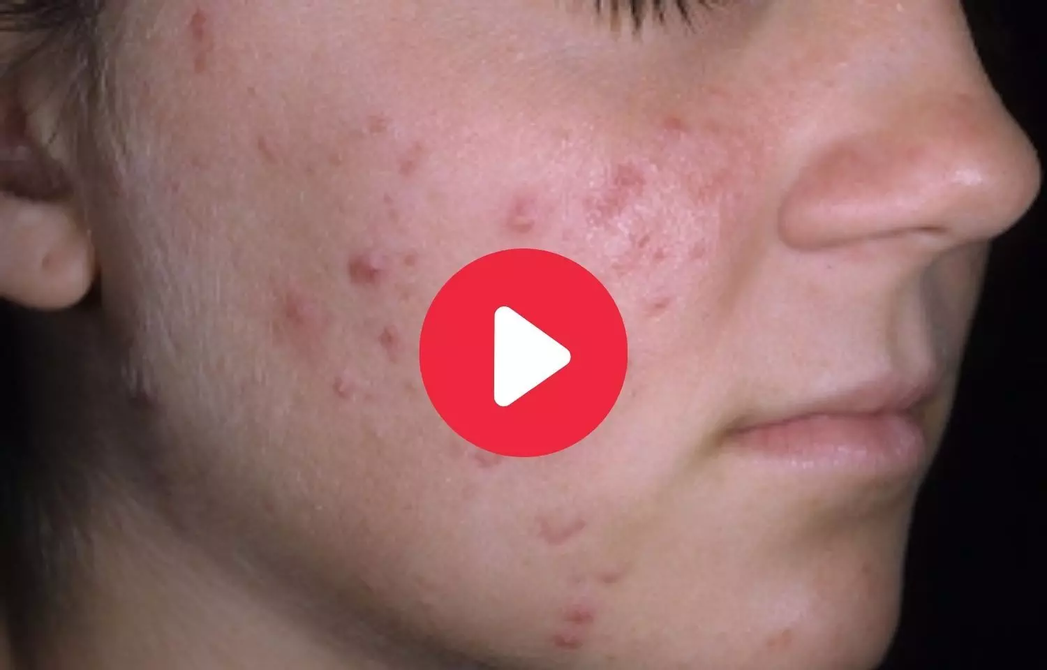 Teenage Acne: Cause, Symptoms, and Treatment