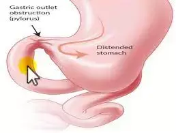 Gastrojejunostomy and endoscopic stenting effective for Gastric outlet obstruction: Study