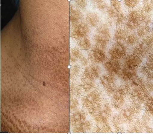 Case of Rare follicular variant of Beckers nevus reported