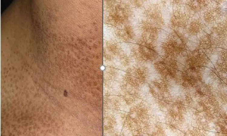 Case of Rare follicular variant of Beckers nevus reported