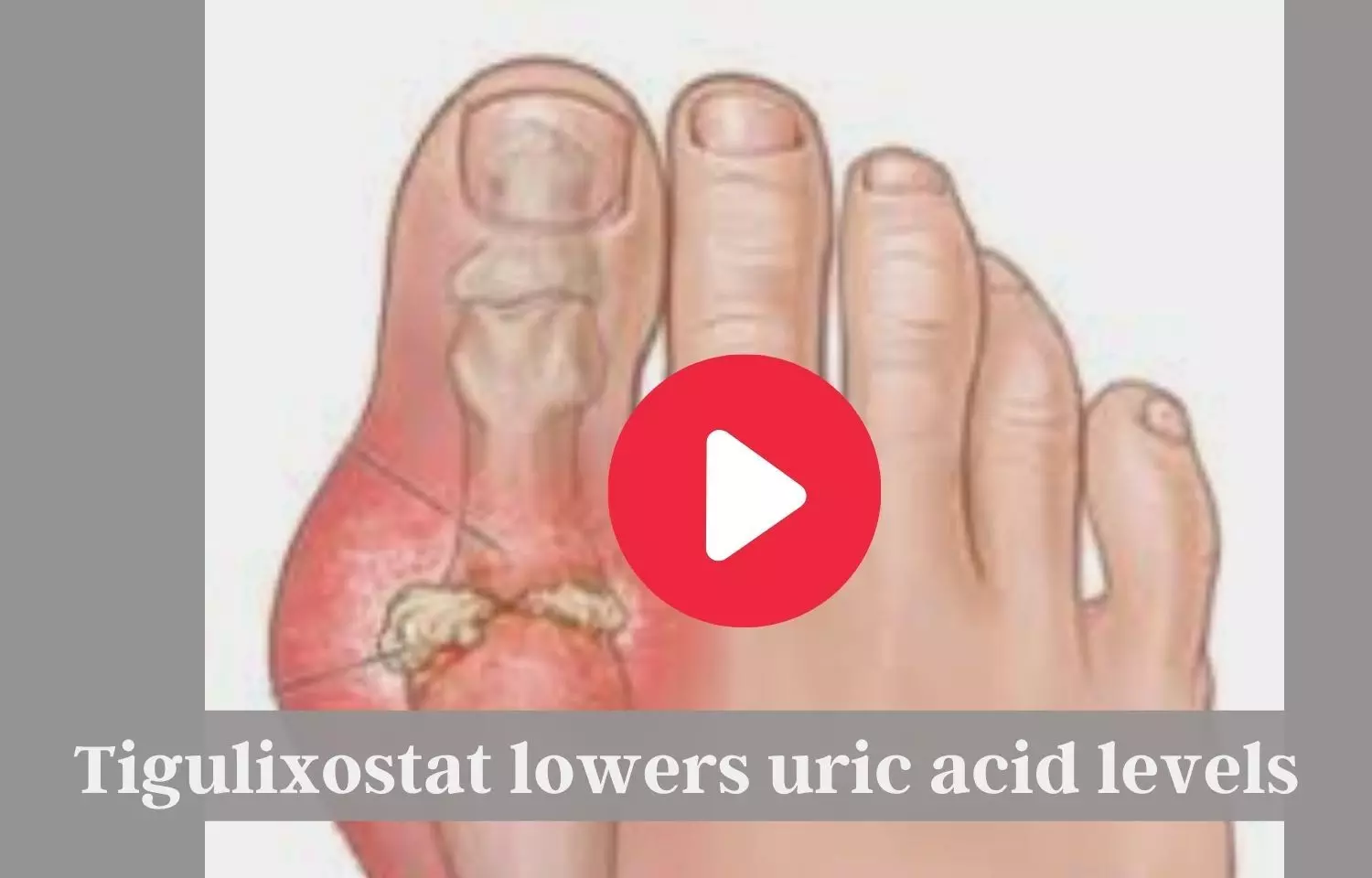Tigulixostat lowers uric acid levels
