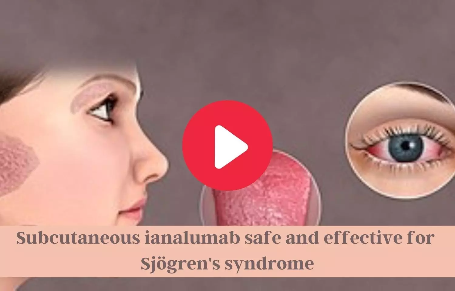 SC Ianalumab considered safe, effective in Sjögrens syndrome