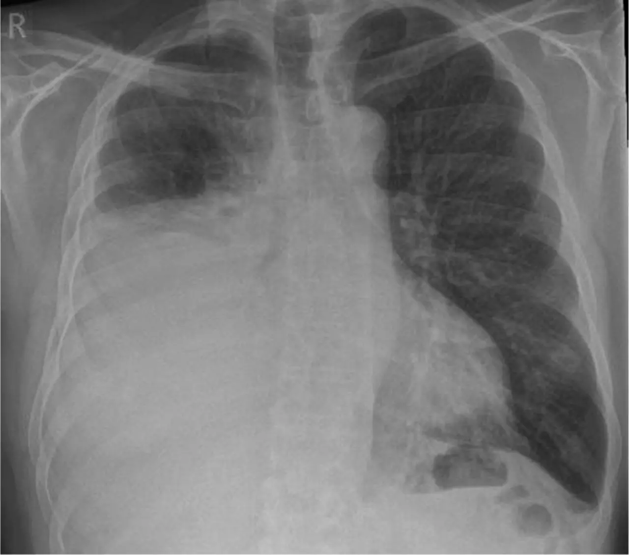 pleural effusion