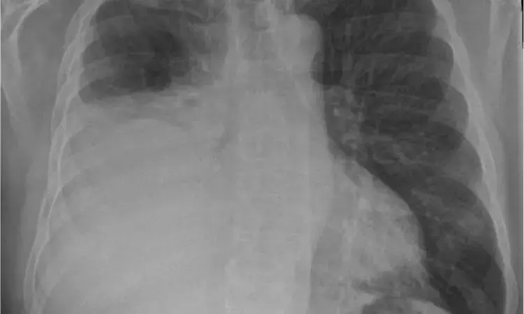 Modern Approach For Unilateral Pleural Effusion: Case study