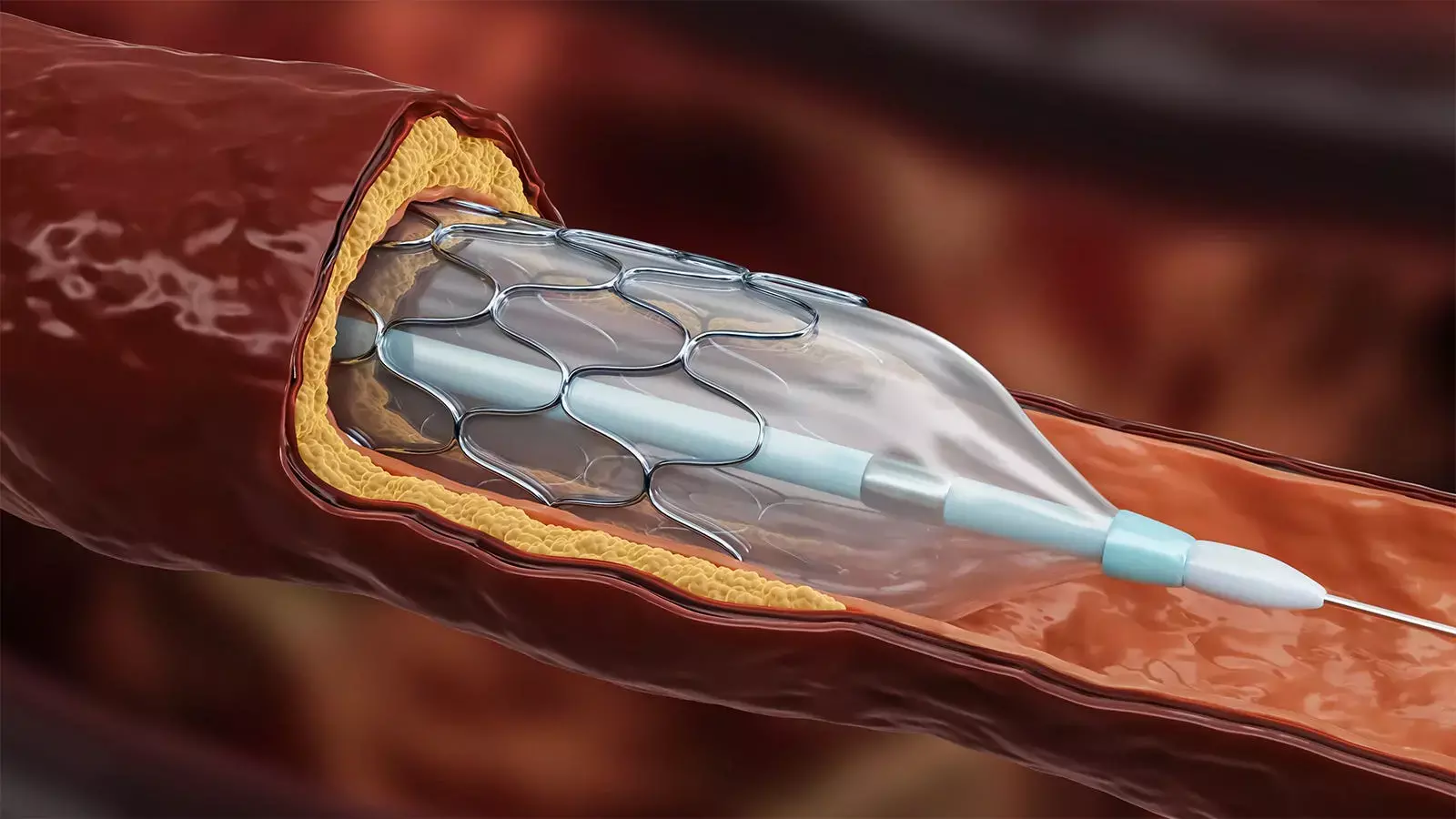 STEMI patients with multivessel CAD benefit most from complete revascularization during the index procedure