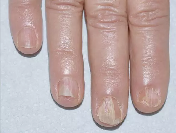 Barcitinib effective in severe nail lichen planus- 1st case report