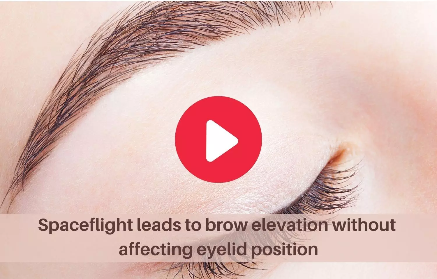 Spaceflight can cause brow elevation without eyelid position change