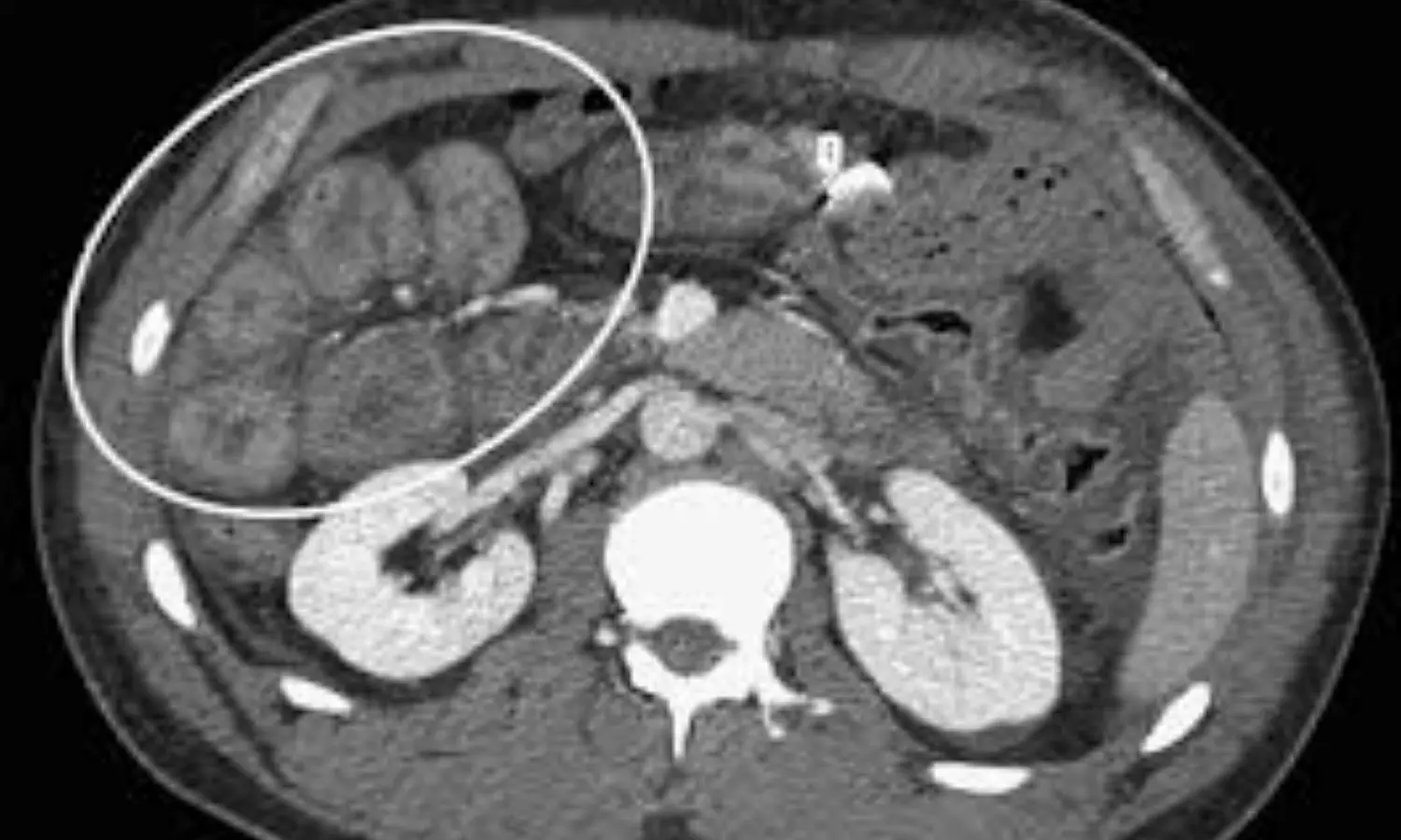 Free fluid on CT, acceptable indicator for surgery in traumatic bowel mesenteric injury: Study