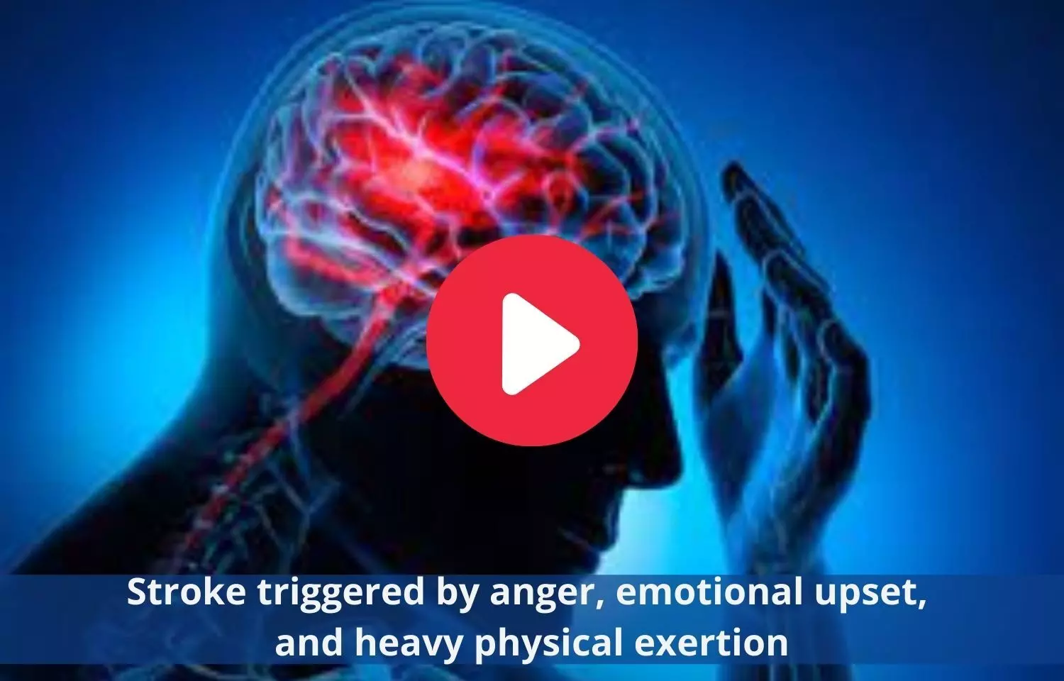 Anger, emotional upset, and heavy physical exertion trigger stroke