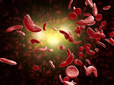 Vitamin D Deficiency Might Aggravate Pain For Sickle Cell Patients