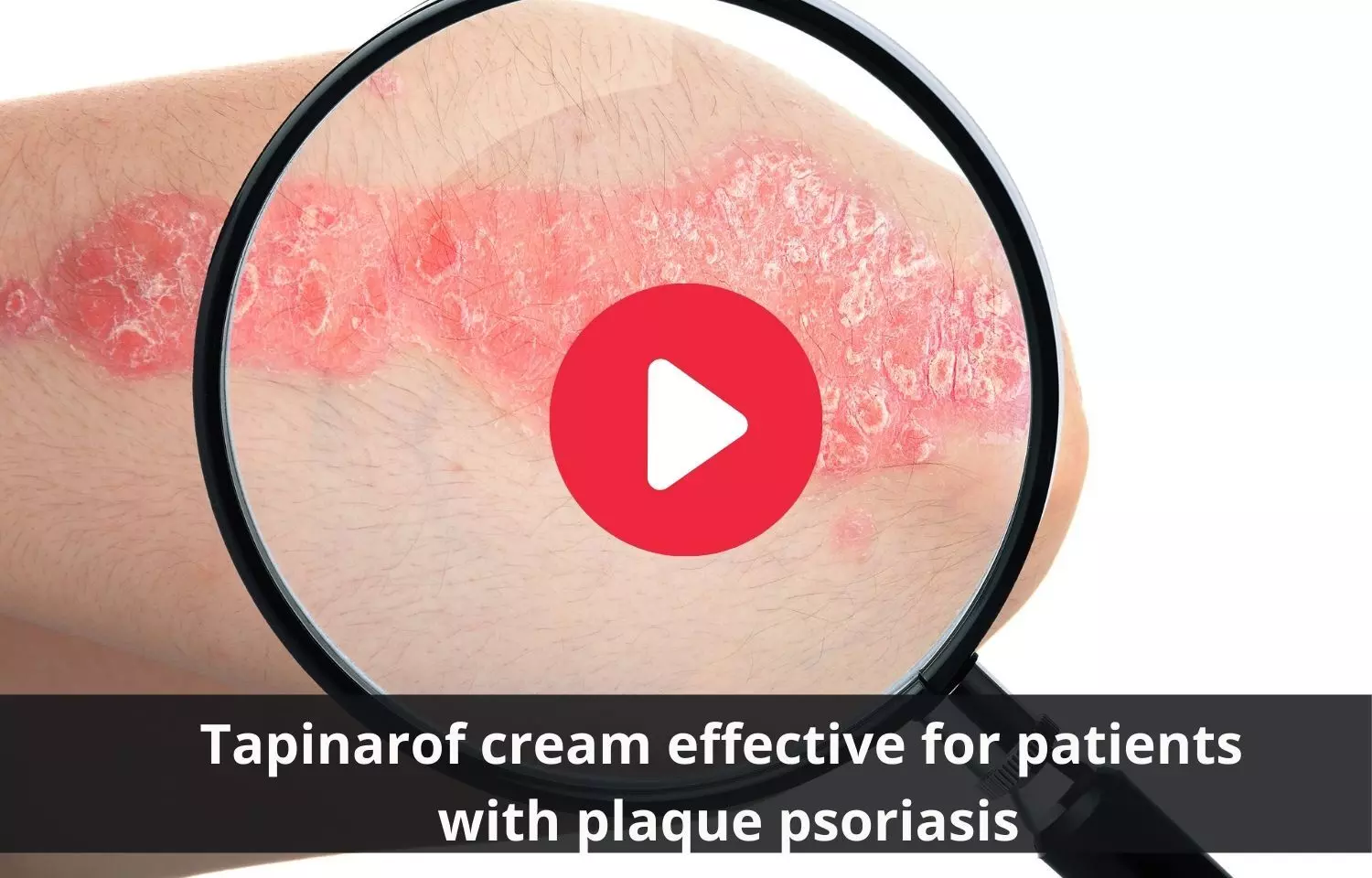 Tapinarof cream beneficial  for plaque psoriasis patients
