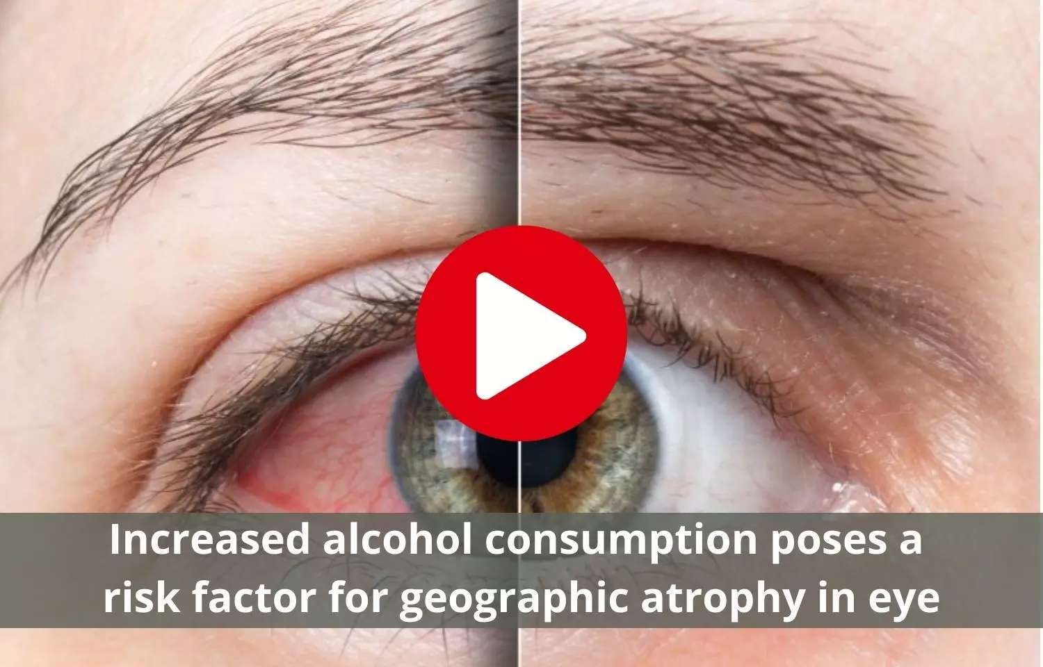Increased alcohol consumption poses a risk factor for geographic atrophy in eye