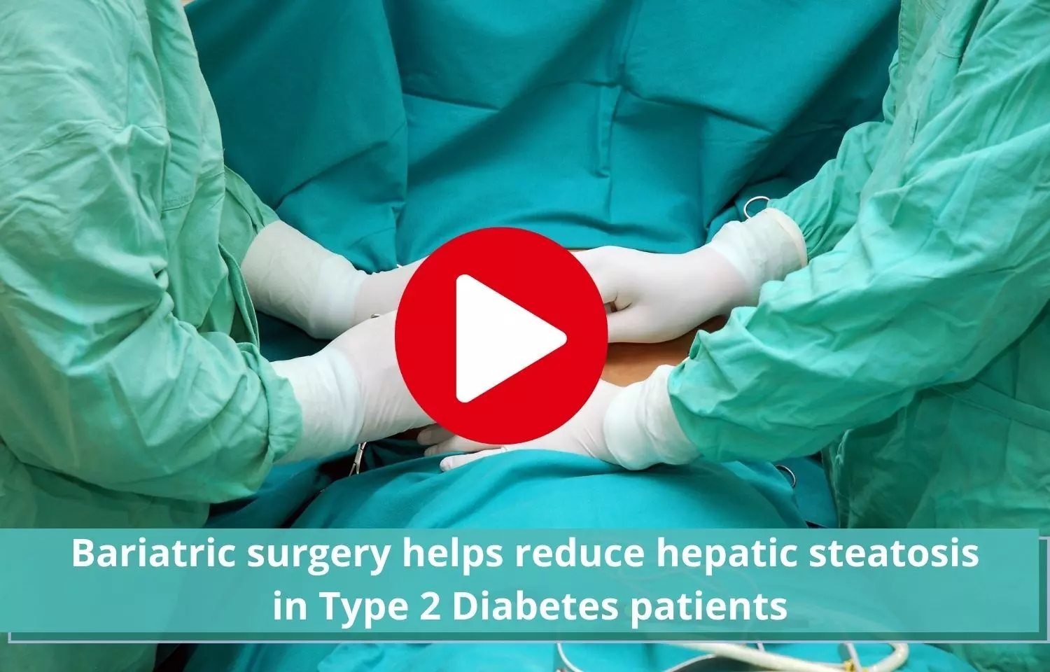 Bariatric surgery helps T2DM patients by reducing  hepatic steatosis