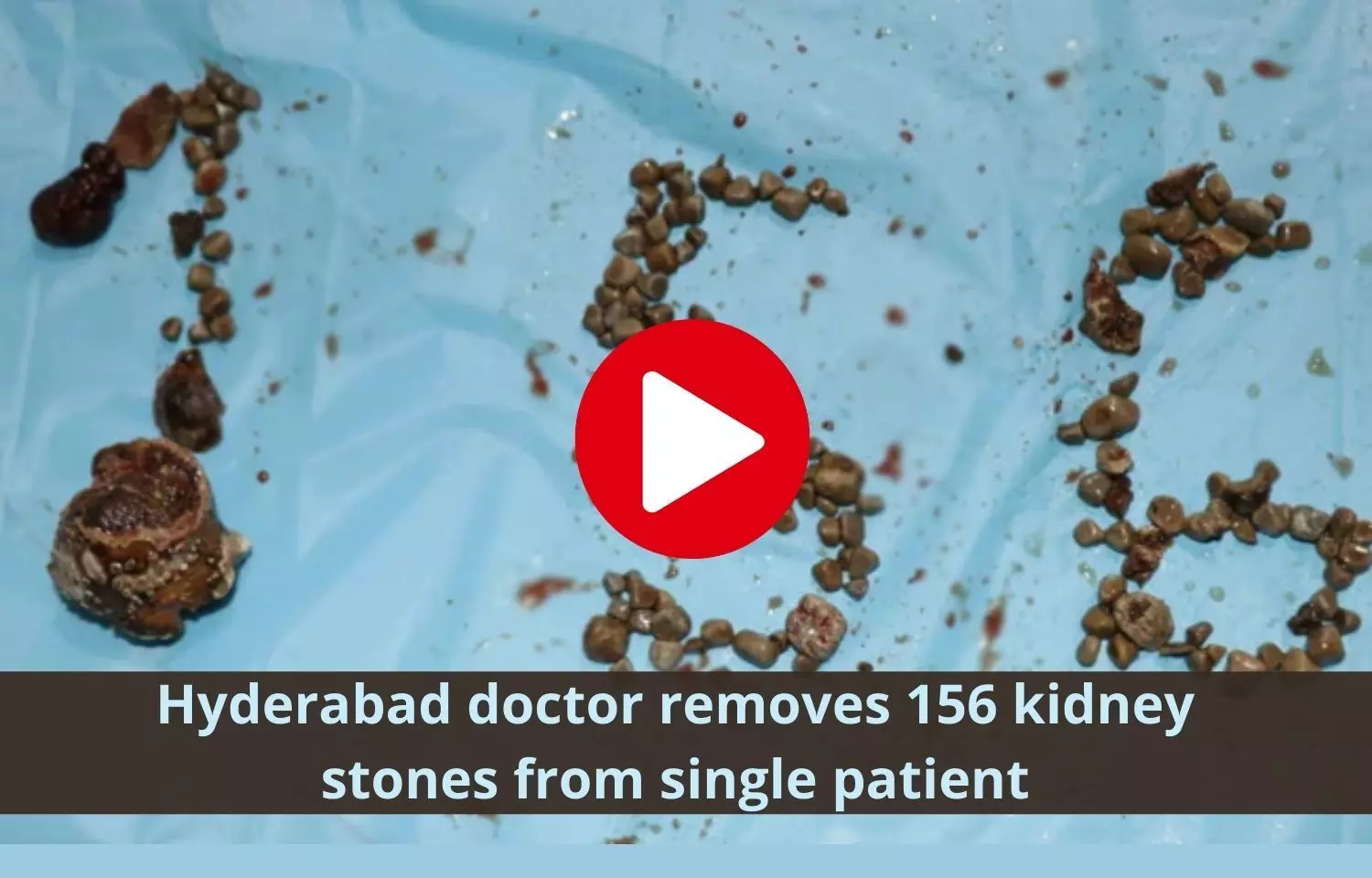 156 kidney stones removed by Dr  V Chandra Mohan at Preeti Urology and Kidney Hospital, Surgery Video