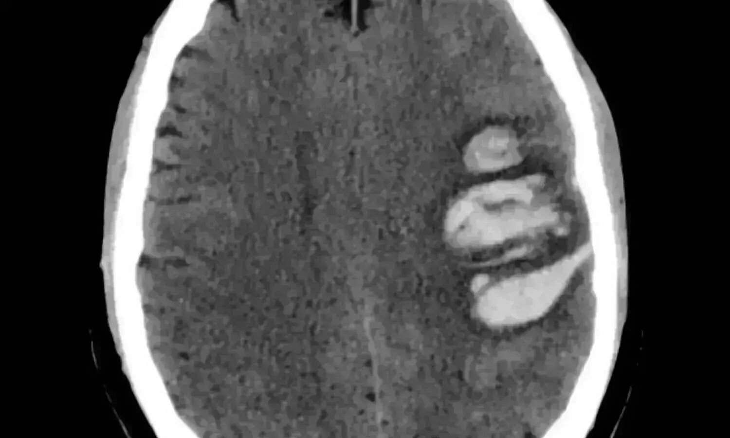 Hominick Hematoma