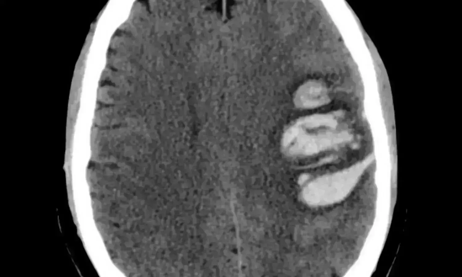 Early minimally invasive hematoma evacuation improves outcomes in acute intracerebral hemorrhage patients: NEJM