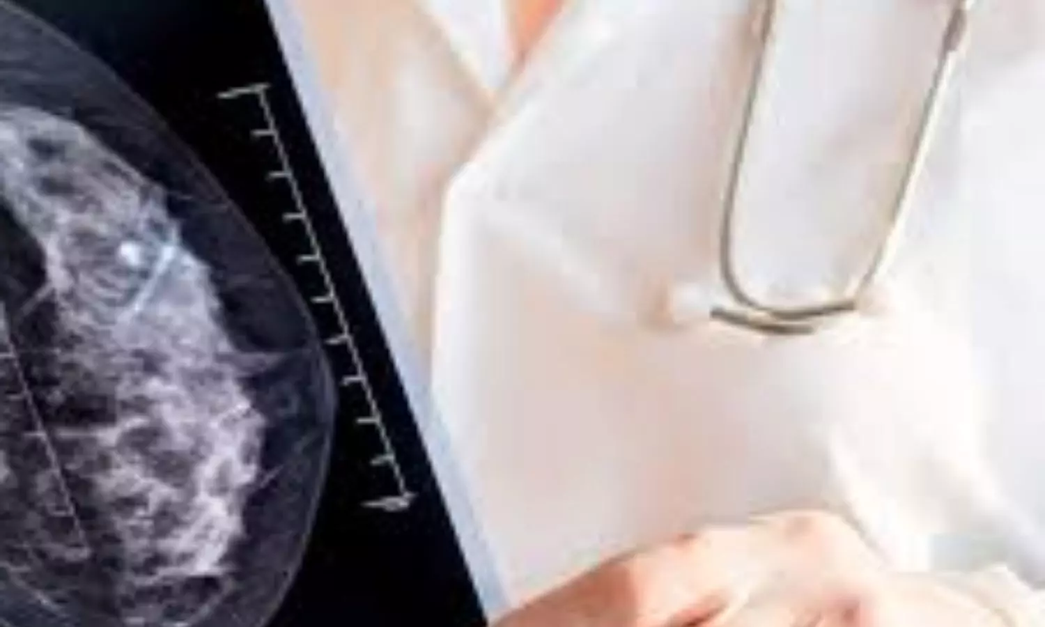 Combo of DBT and synthesized mammography has higher detection rate of breast cancer, says study