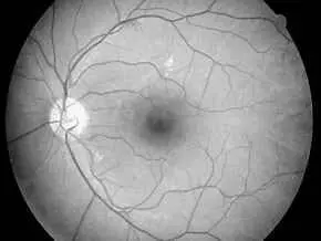 Challenges in the Clinical Management of Proliferative Diabetic Retinopathy: Treatment Choice and Follow-up