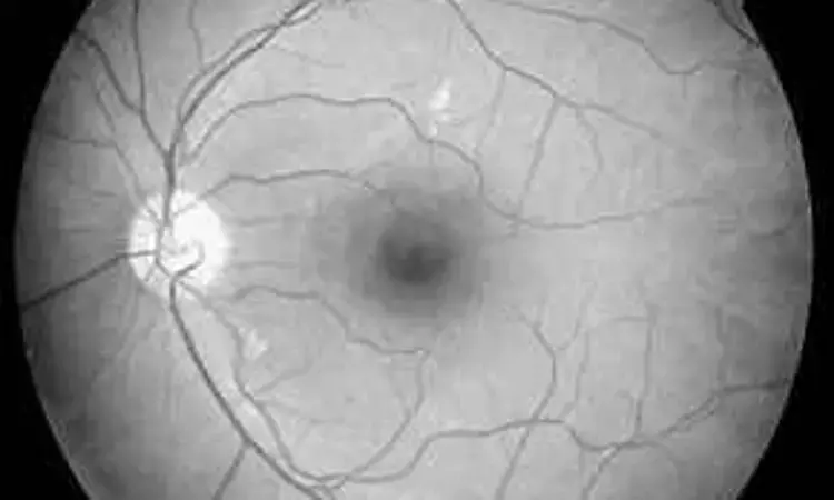 Ring Amplitude and its effects on Diabetic eyes - A Multifocal electro retinography study